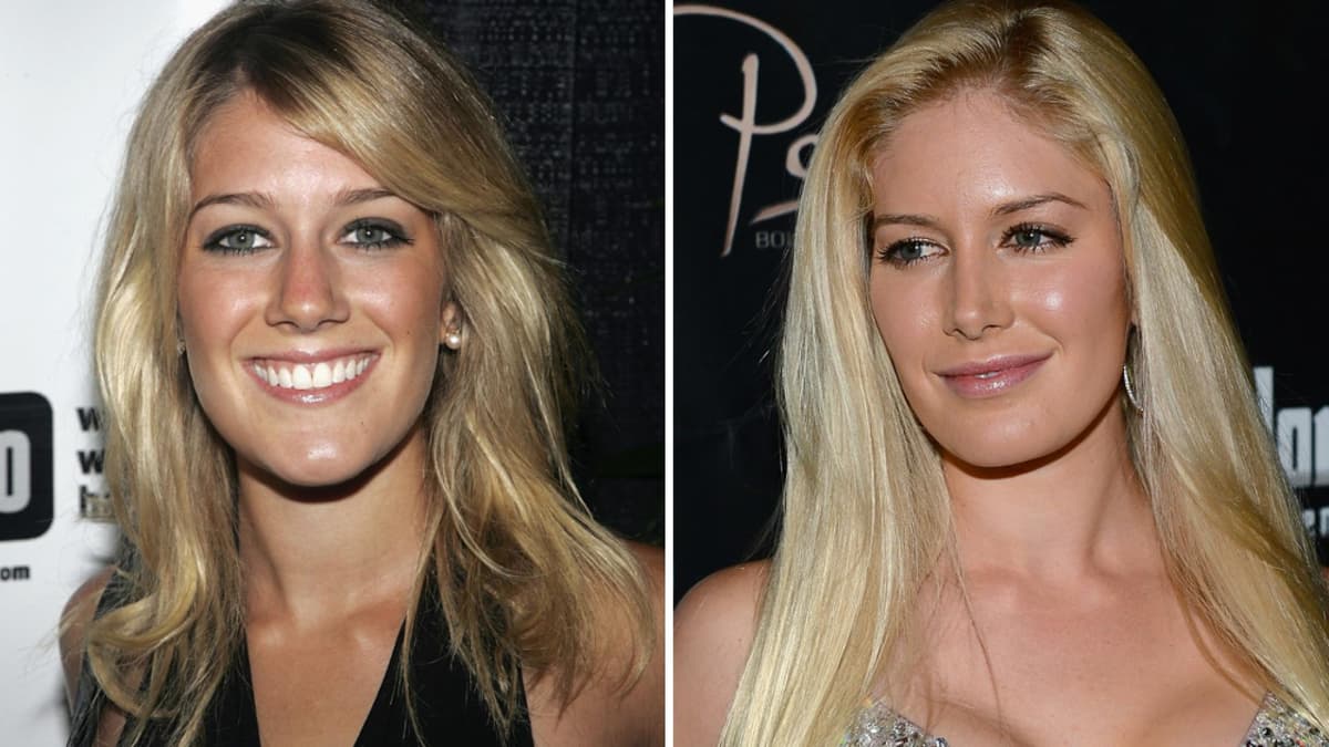 Heidi Montag vor und nach Schönheits-OP