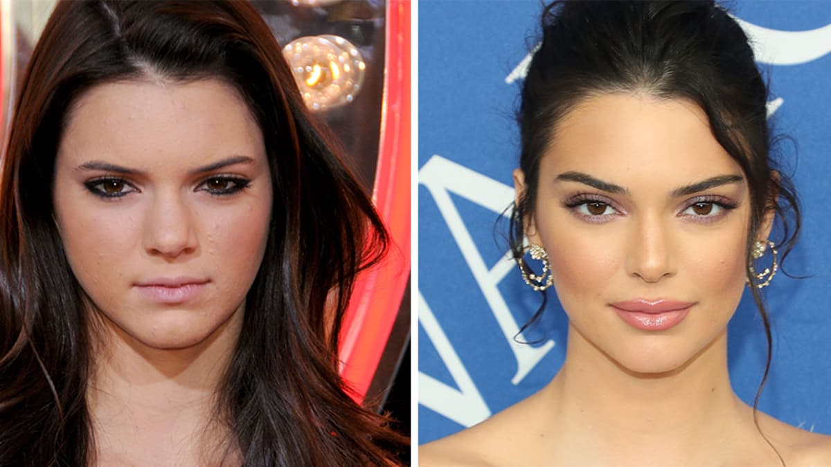 Kendall Jenners Gesicht vor und nach OPs