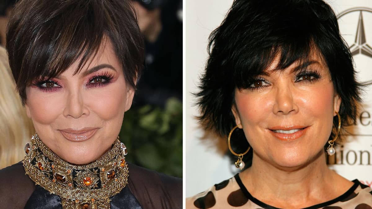 Kris Jenners Gesicht vor und nach OPs