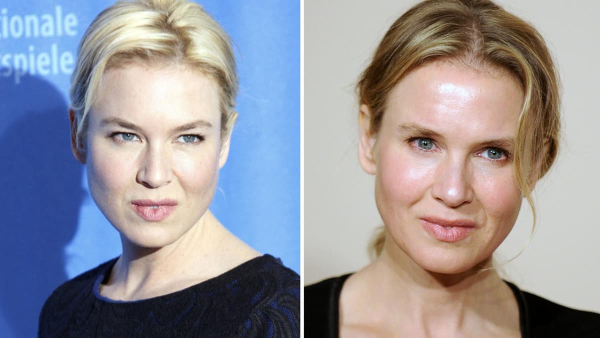 Renée Zwellweger vor und nach Beauty-Eingriff