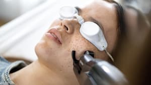 Frau testet den Alma Laser