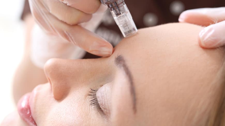 Frau bekommt eine Dermapen Anwendung