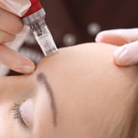 Frau bekommt eine Dermapen Anwendung