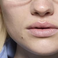 Pigmentflecken Lippe Pigmentflecken an der Lippe
