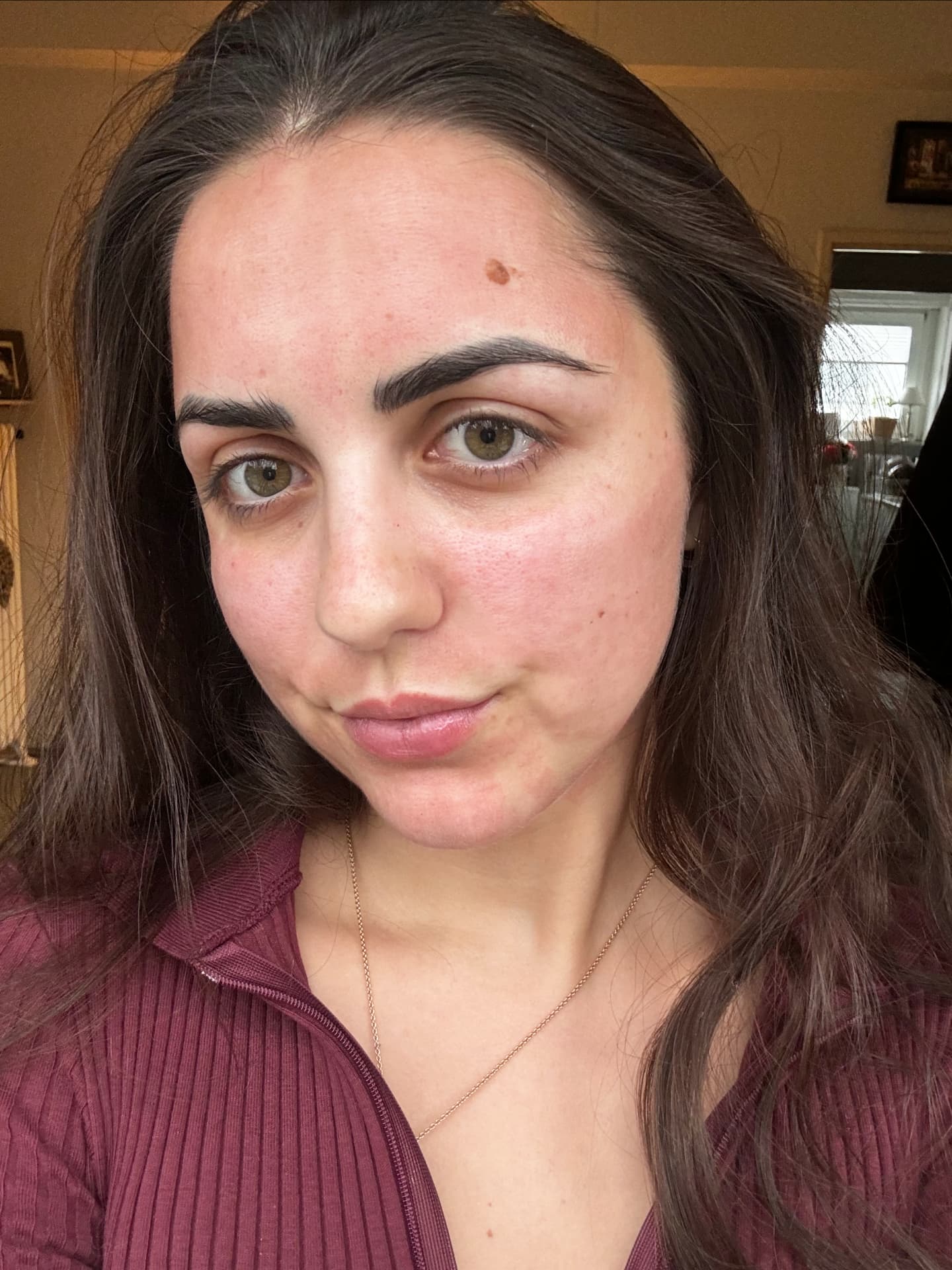 Radiofrequenz-Microneedling