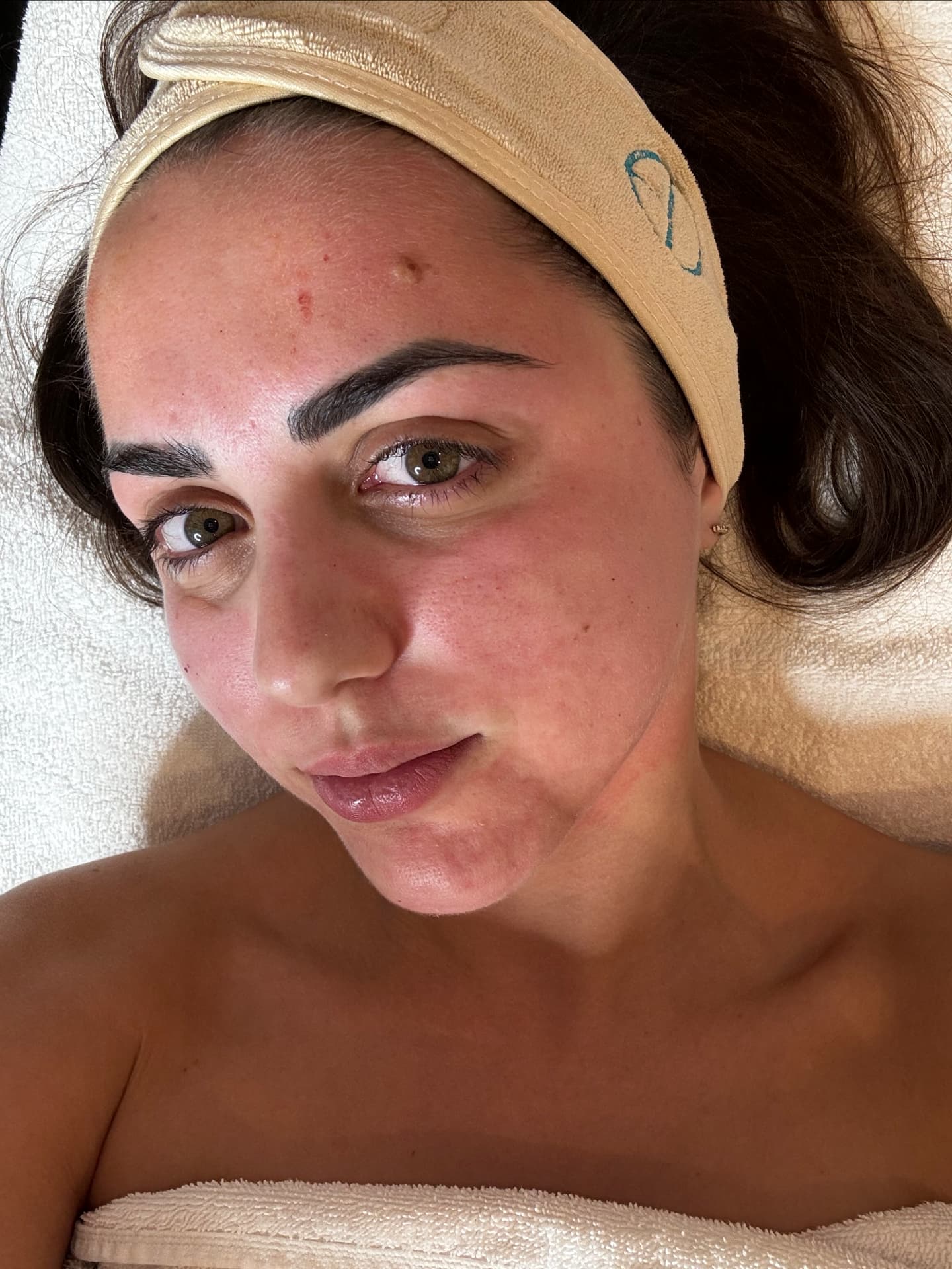 Radiofrequenz-Microneedling