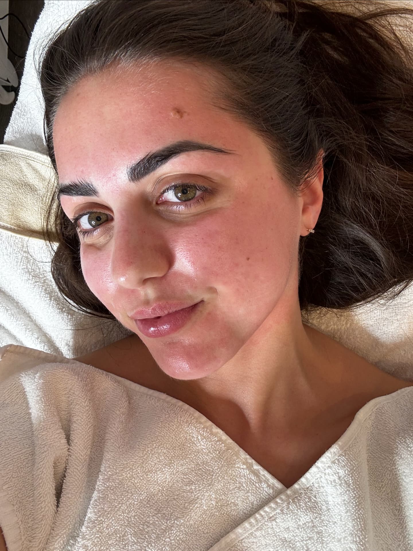 Radiofrequenz-Microneedling 