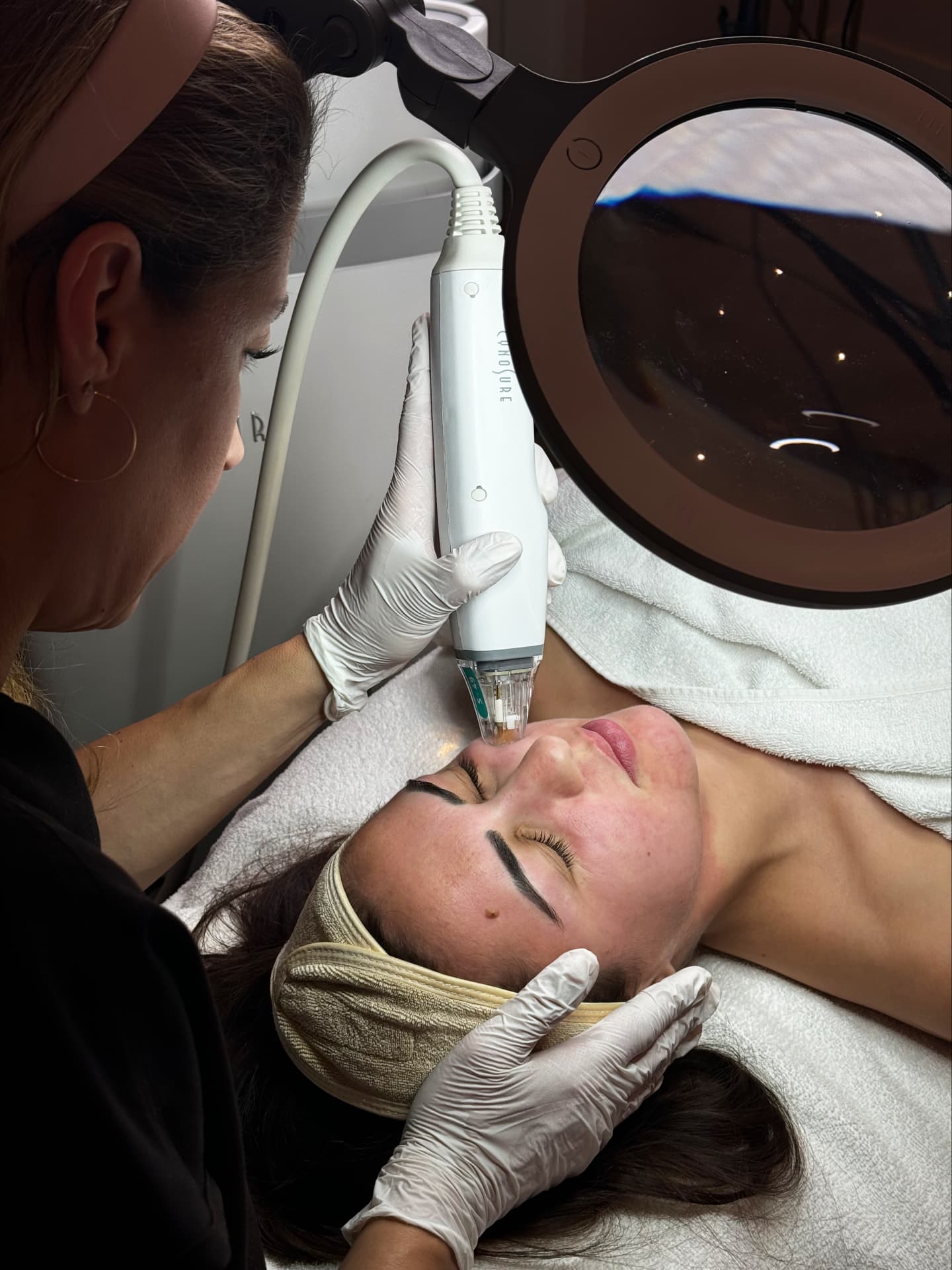 Radiofrequenz-Microneedling