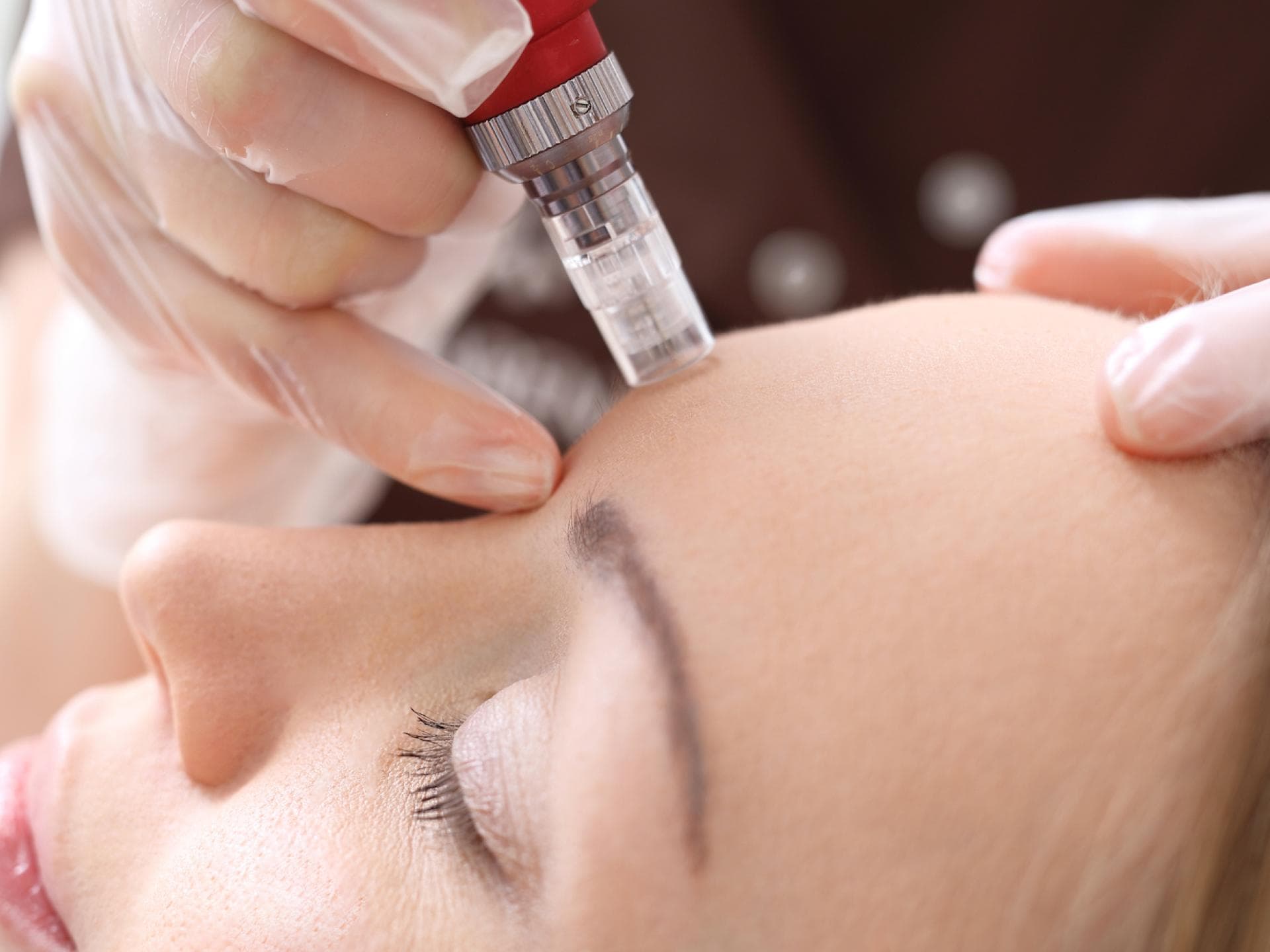 Frau bekommt eine Dermapen Anwendung