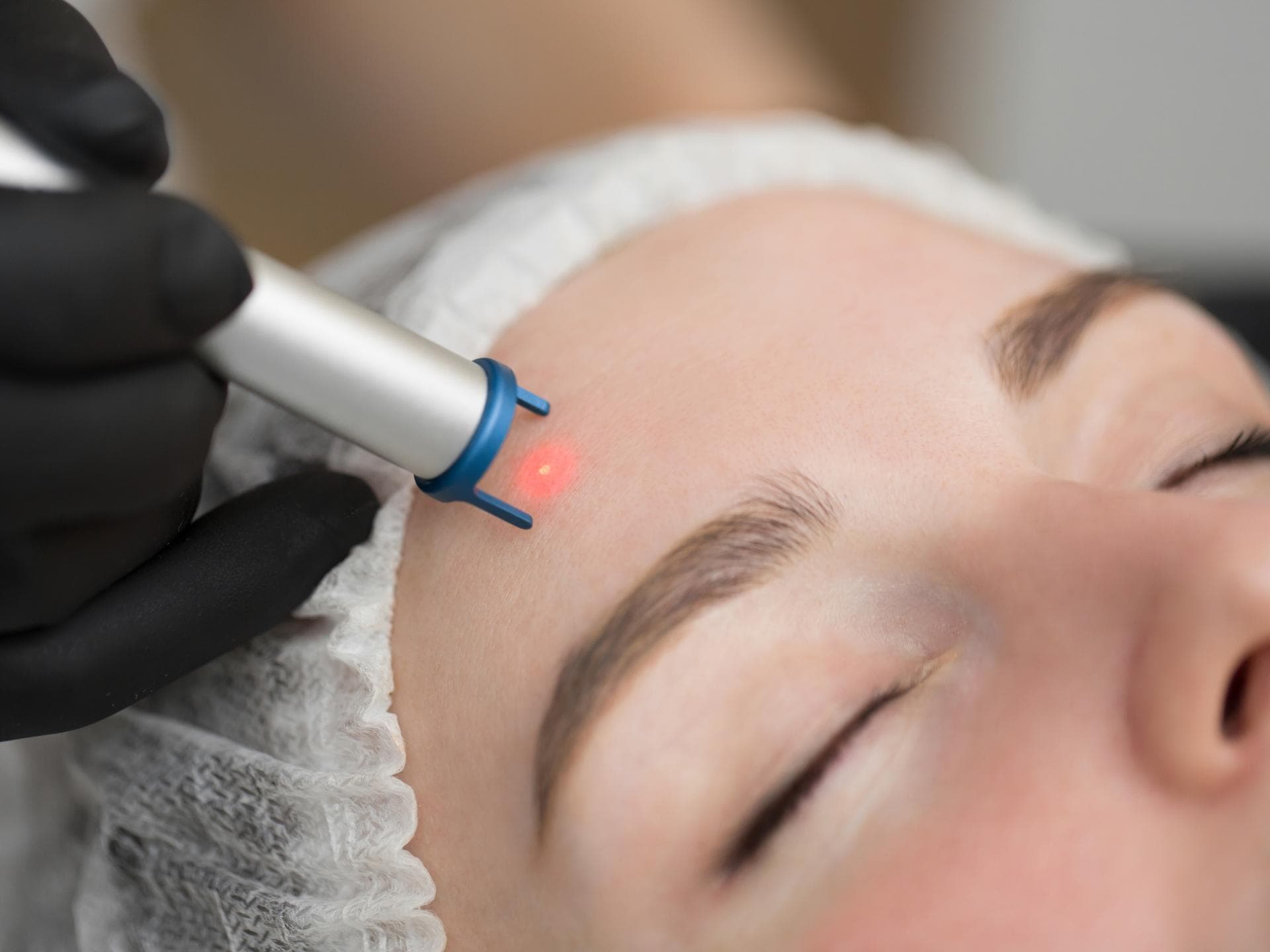 Anti-Akne Laser Behandlung