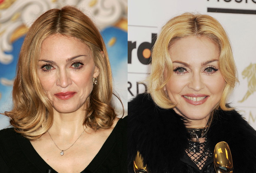 Stars Mit Botox Vorher & Nachher: Diese Stars hatten Botox-Behandlungen