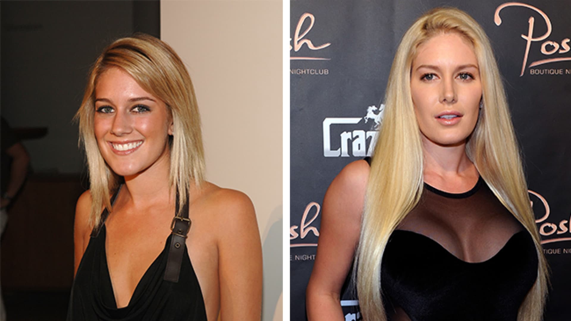 vorher nachher brustvergrosserungen der stars