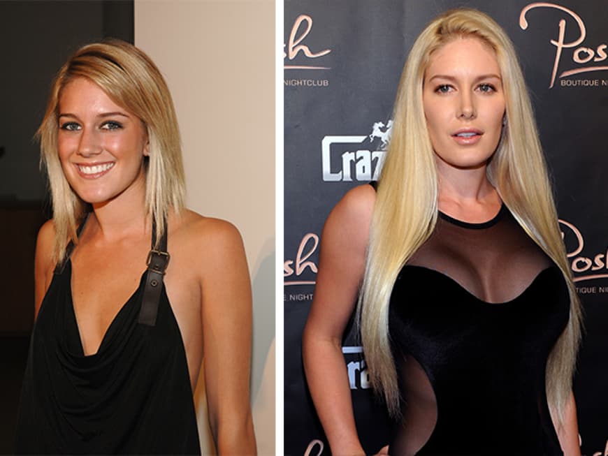 Pamela Anderson vorher und nachher